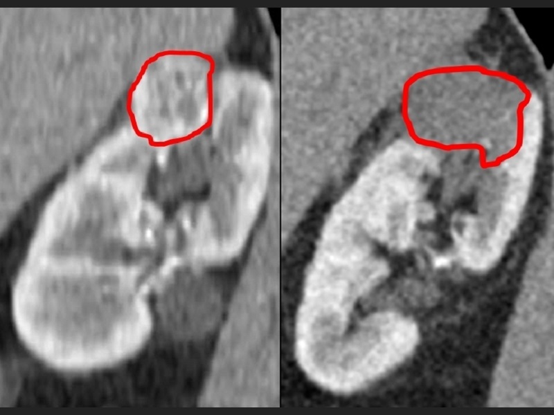 krioablacja_raka_nerki_przed_i_po