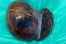 usunieta-watroba-biorczyni